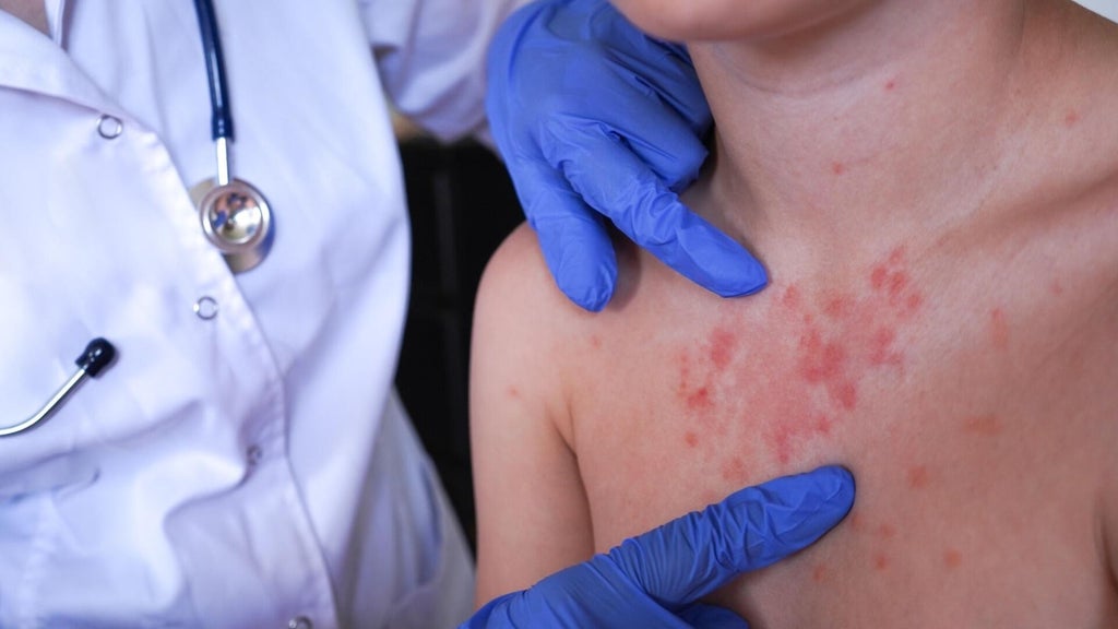 Minnesota's 80 measles cases this year are the most since 1990, health officials say — Hastings Health news