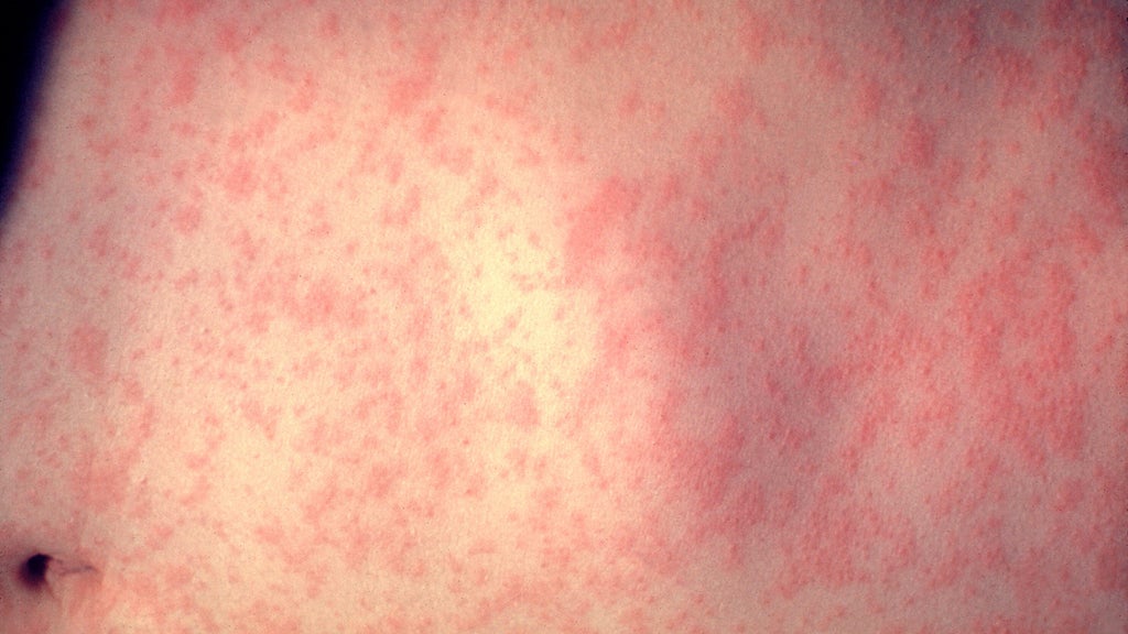 25 cases of measles identified in central, southeastern Minnesota, MDH says — WCCO / CBS Minnesota, Hastings Health news